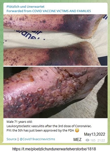 "Corona" vaccine damage on
                            May 13, 2022 with leukocytoclastic
                            vasculitis (phlebitis) after the 3rd
                            "Corona vaccination"
