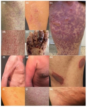 "Corona" vaccine damage: combined
                        photo with rash and black toes