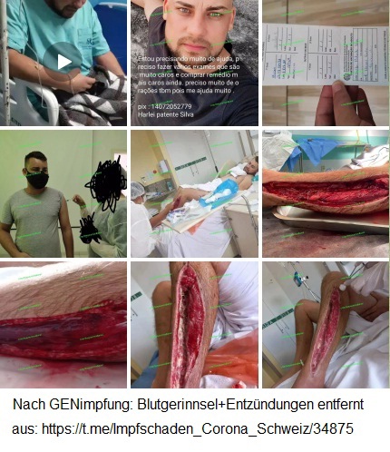 "Corona"
                        vaccine damage: From a leg, blood clots and
                        inflammation were surgically removed