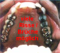 Amalgamgebiss 03, man
                          muss immer mit Rissen und Br�chen rechnen,
                          wobei die Bruchstellen eine weit h�here
                          Quecksilbervergiftung provozieren als normal