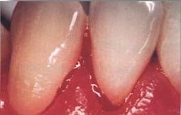 Zahnfleischbluten kann durch
                            eine Quecksilbervergiftung der
                            Mundschleimhaut durch Amalgam-Quecksilber
                            stark beg�nstigt sein und gef�hrdet so die
                            Z�hne