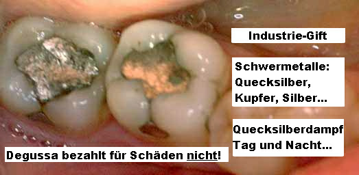 Amalgamf�llungen: Degussa bezahlt f�r die Sch�den
                  nicht
