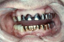 Amalgamgebiss mit Frontz�hnen aus Amalgam