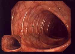 Un canal intestinal
                        sano va ser cubierto con mercurio de amalgama, y
                        por eso la flora intestinal va ser debilitado
                        mucho. Pues no se puede defender mucho m�s
                        contra hongos y otros agentes pat�genos, y as�
                        hongos pueden difundirse en el intestino, y esos
                        hongos por otra parte van almacenar metales
                        pesados. La medicina "convencional" y
                        los gobiernos criminales y adictos de la bolsa
                        simplemente no quieren ver eso...