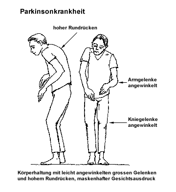 Personas afectadas
                        por la enfermedad de Parkinson tienen m�s
                        amalgamas en sus bocas que personas sin
                        Parkinson. Parkinson tambi�n es causado por
                        pesticidas y por impregnantes para la madera.