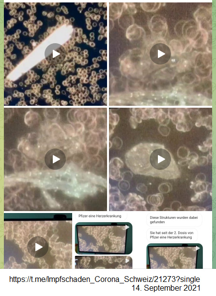 Sammelfoto �ber
                    gesundes und zerst�rtes Blut durch GENimpfung,
                    14.9.2021