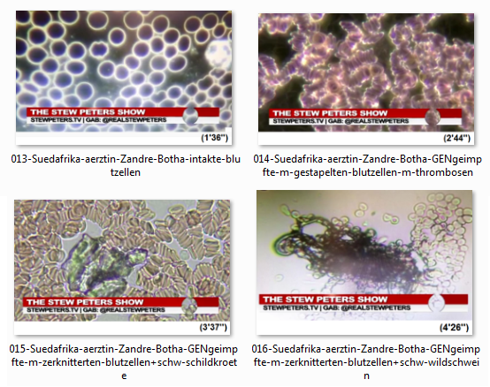 S�dafrika Frau Dr. Zandre
                      Botha zeigt Beispiele gesunder Blutzellen und
                      GENgeimpftes Blut: Blutzellen sind
                      aufeinandergestapelt+schwarz-gr�nes und schwarze
                      Objekte im Blut