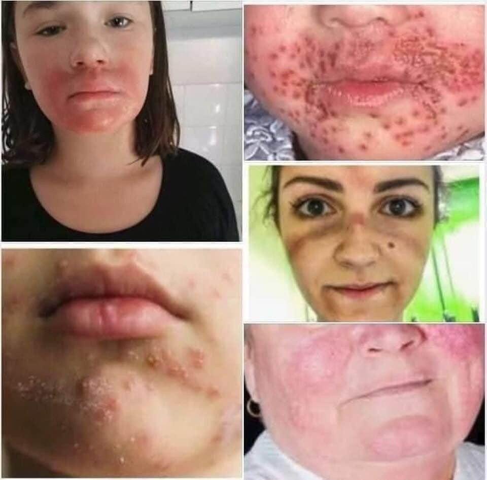 Folgesch�den des Maskentragens
                    bei Hitze (Foto:Netzfund)