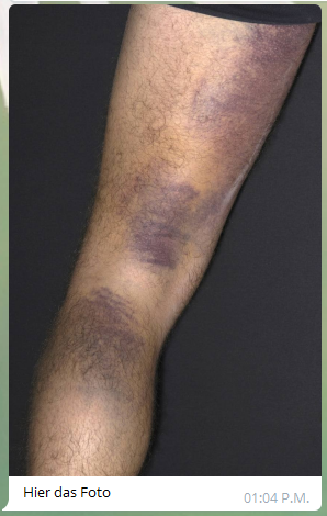4R am 7.6.2021: Violette Flecken am Bein
                  und im Gesicht