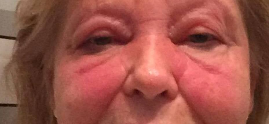 Genimpfung provoziert
                  Ausschlag im Gesicht, Kanton Tessin 13.6.2021