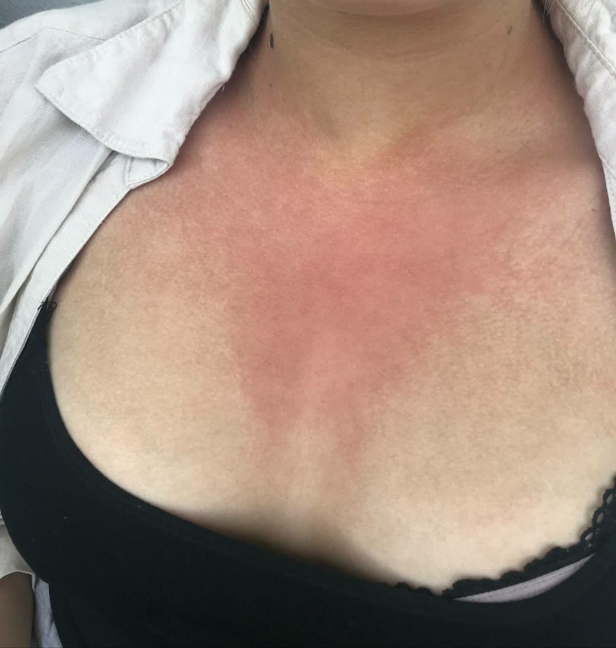 Shedding D-A-CH 21.6.2021: Rötung im
Dekolletée-Bereich nach Kontakt mit Gengeimpften Shedding D-A-CH 21.6.2021: Rötung im
Dekolletée-Bereich nach Kontakt mit Gengeimpften