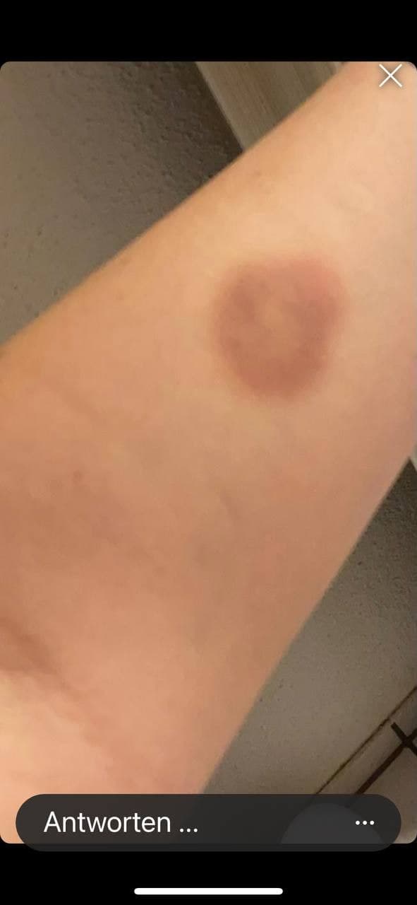 Fleck nach der 2. Genspritze Moderna 03