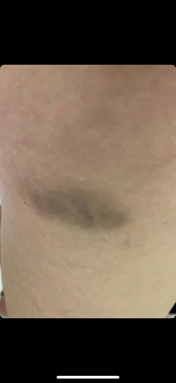 Fleck nach der 2. Genspritze Moderna 02