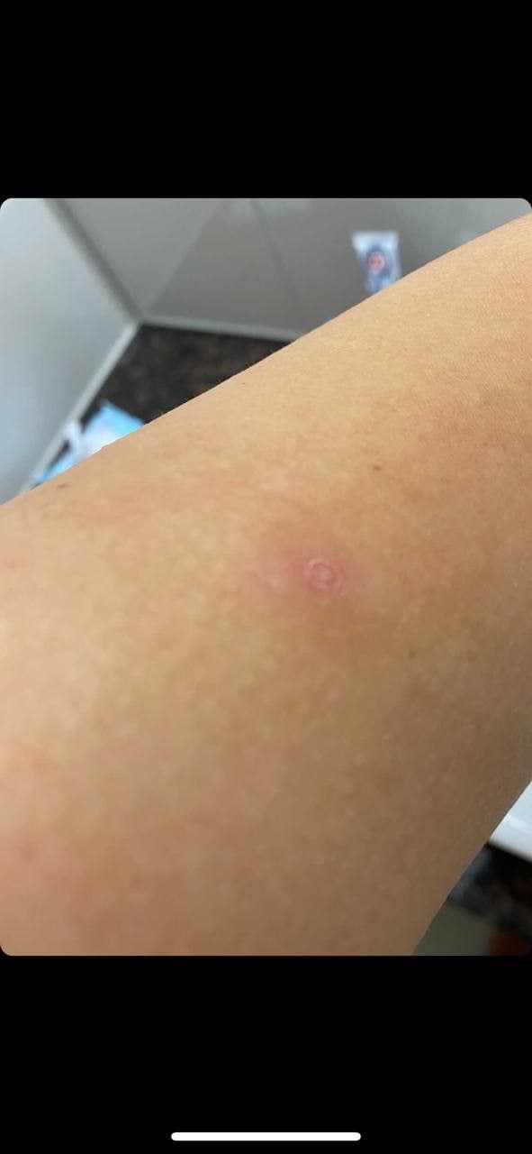 Fleck nach der 2. Genspritze Moderna 01