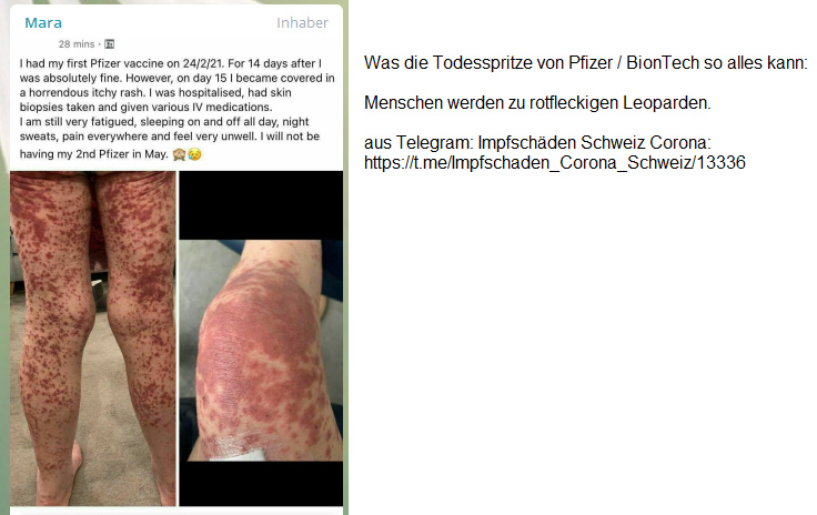 18.6.2021: PFIZER zerst�rt die Gesellschaft:
                Menschen werden zu rotfleckigen Leoparden