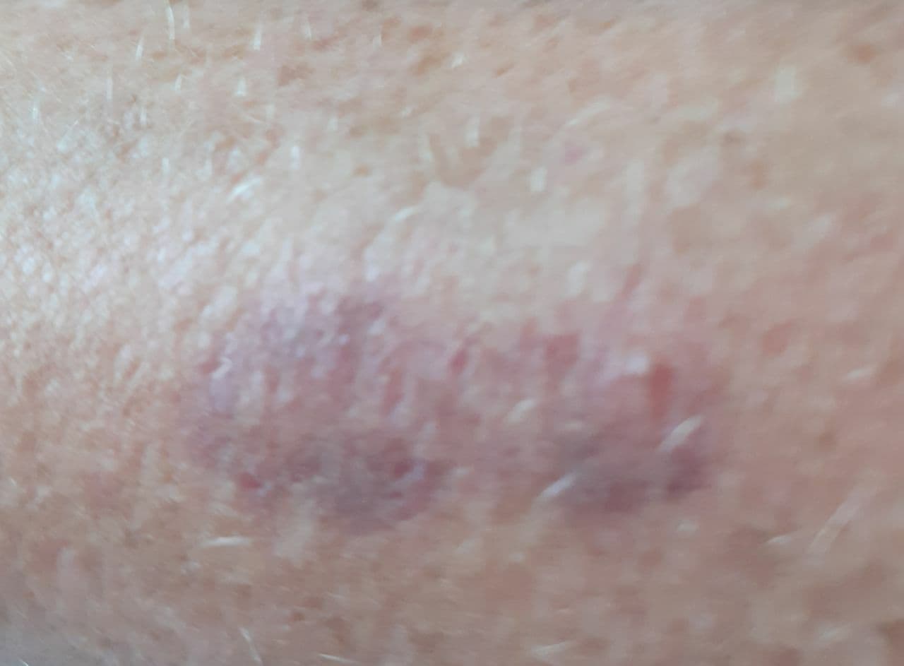 Shedding provoziert blaue Flecken, 28.6.2021