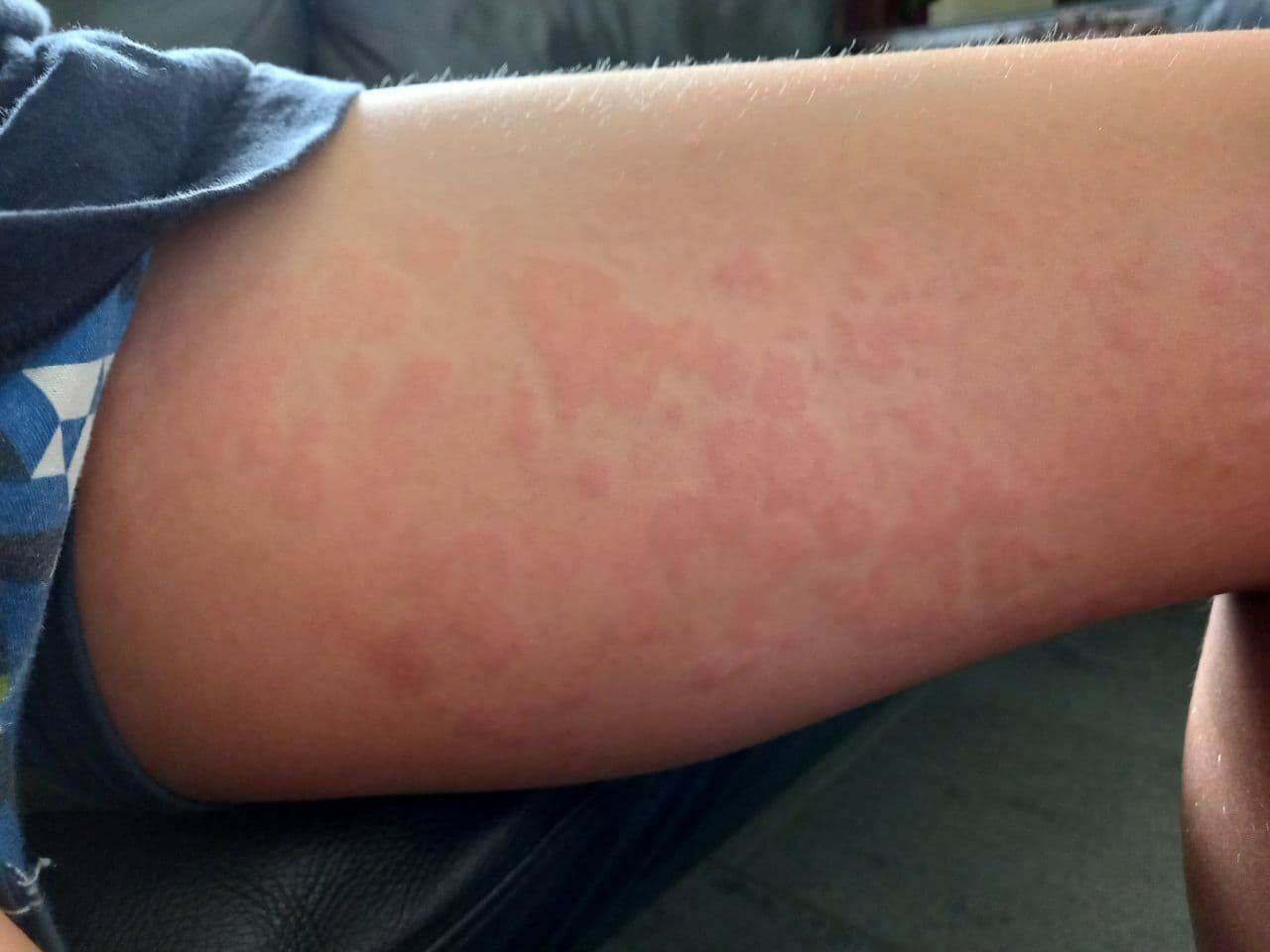 Shedding: Ausschlag
                      an beiden Oberschenkelinnenseiten