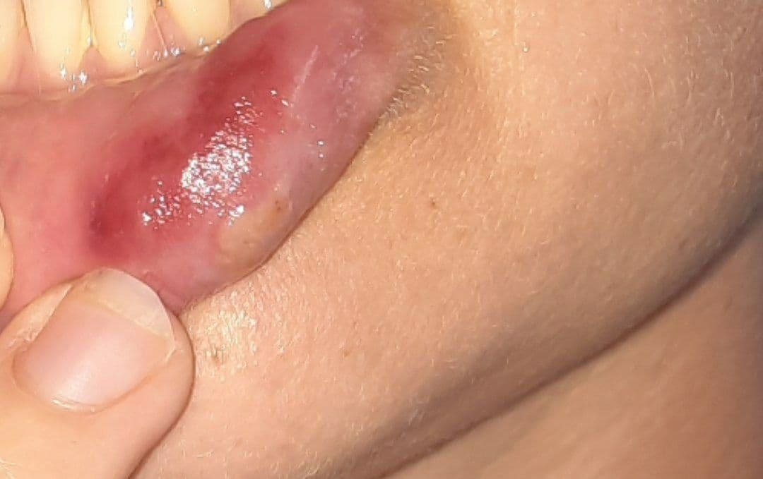 Shedding
                    Lippengeschw�r