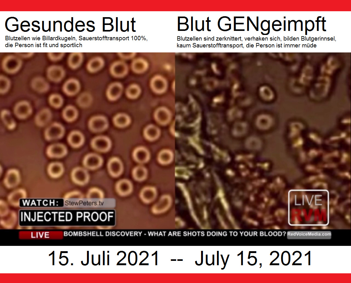 GESUNDE Blutzellen - und
                          GENgeimpfte Blutzellen: Letztere sind
                          verknittert und teilweise schon verklumpt,
                          Thrombosen k�ndigen sich an