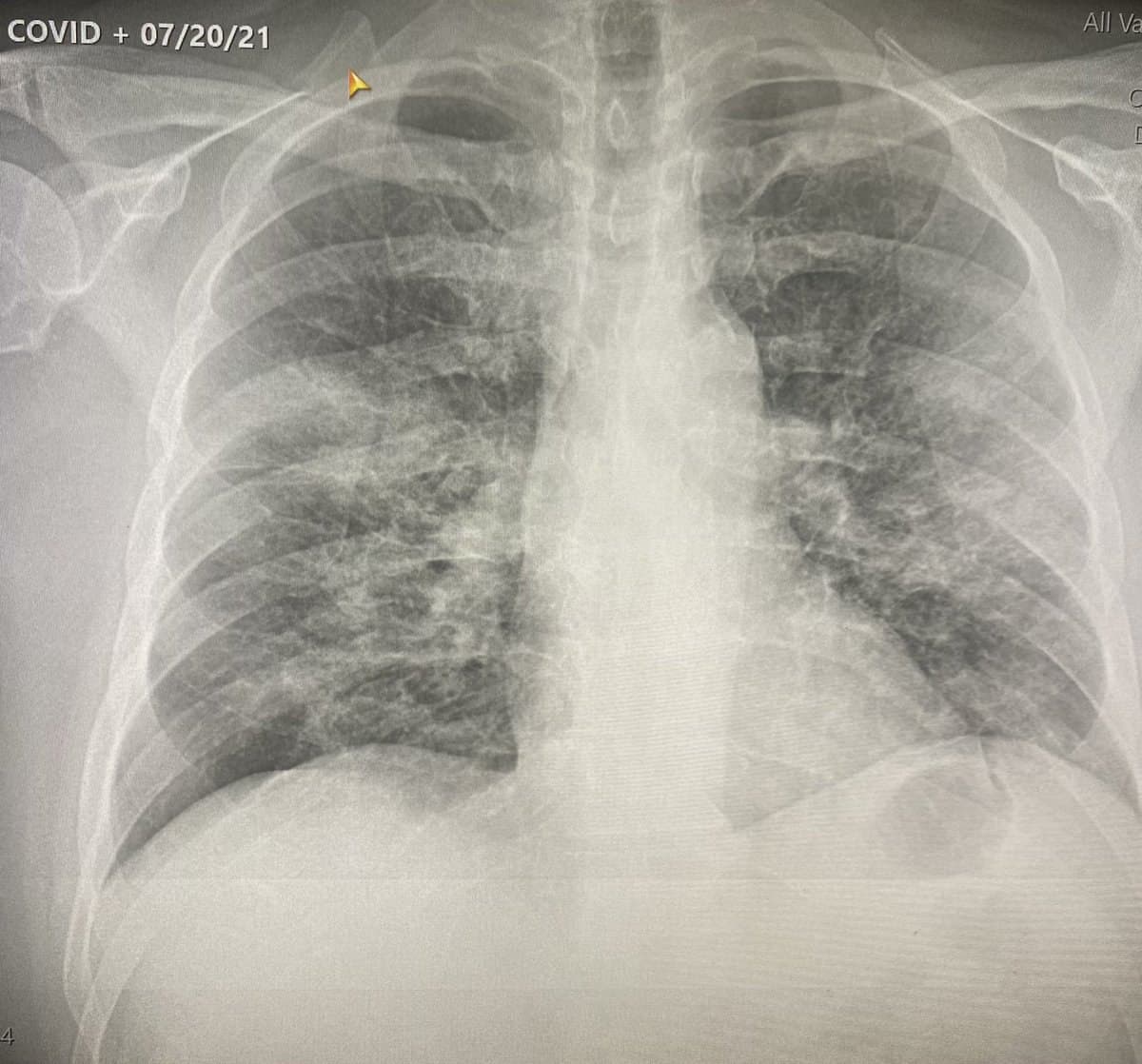 GENimpfung n�tzt nichts in den "USA"
                    7.8.2021: 2fach Pfizer GENgeimpfter wird
                    Corona19-positiv und hat Lungenprobleme