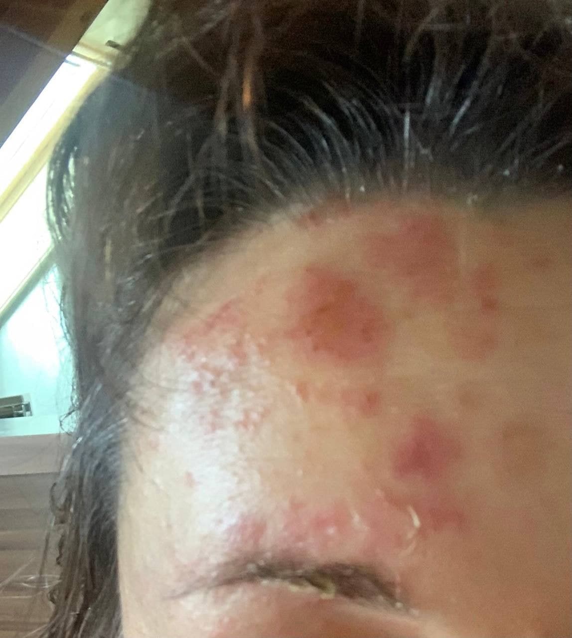 GENimpfschaden Schweiz
                    15.8.2021: Herpes Zoster seit 2 Monaten: