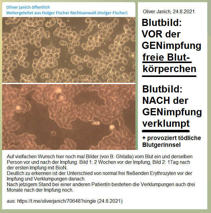 GENimpf-Nebenwirkungen 24.8.2021: GENimpfung
                  provoziert verklumptes Blut und Blutgerinnsel - Fotos