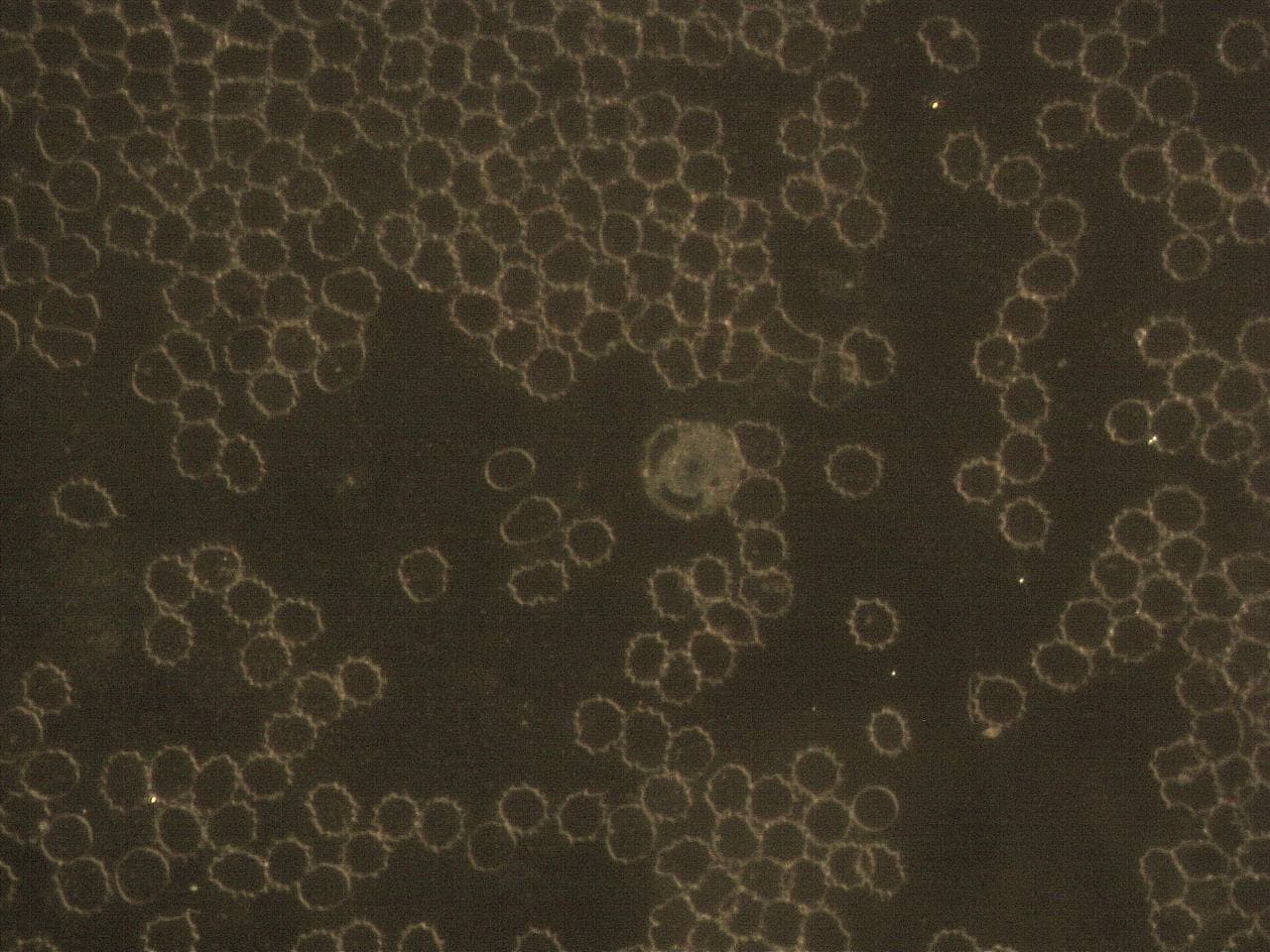 GENimpfschaden im Blutbild
                            15.9.2021: Foto 5