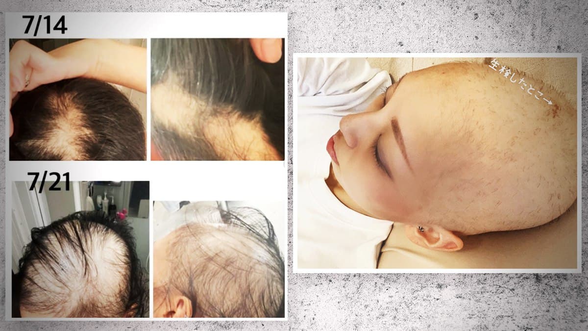 GENimpfschaden Haarausfall in der Schweiz
                  21.9.2021: Die Leute denken, die Person hat Krebs:
                  "Alle denken, ich h�tte Krebs": Immer mehr
                  F�lle von schwerem Haarausfall nach Impfung