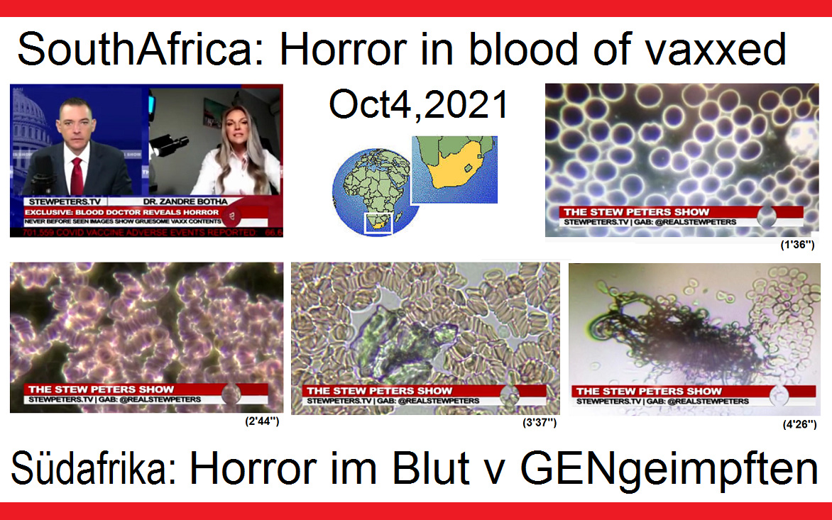 Dr. Zandre Botha in
                S�dafrika entdeckt das zerst�rte Blut der GENgeimpften
                mit schweren Symptomen und schwarzen Objekten drin