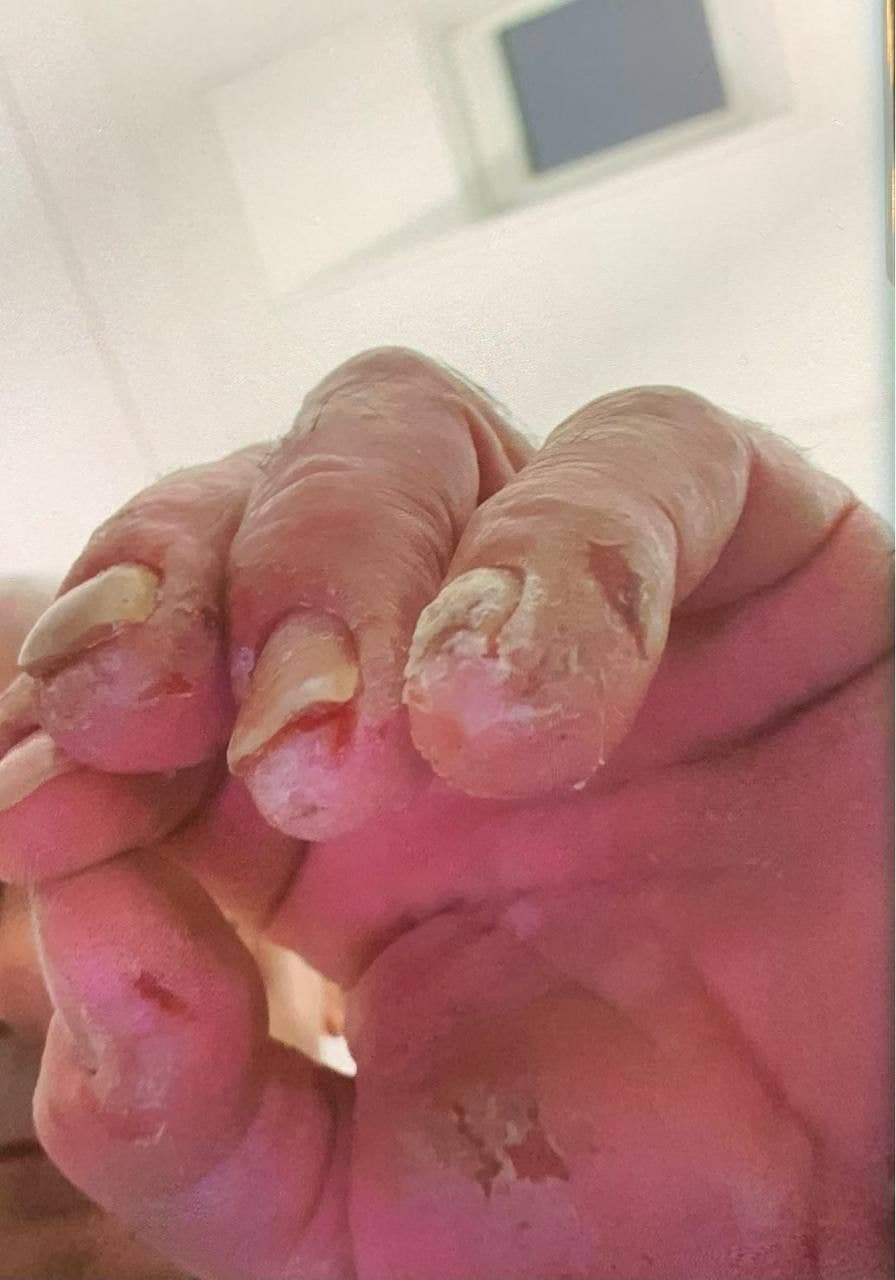 GENimpfschaden Schweiz 20.10.2021: Kaputte
Finger durch GENimpfung GENimpfschaden
Schweiz 20.10.2021: Kaputte Finger durch
GENimpfung