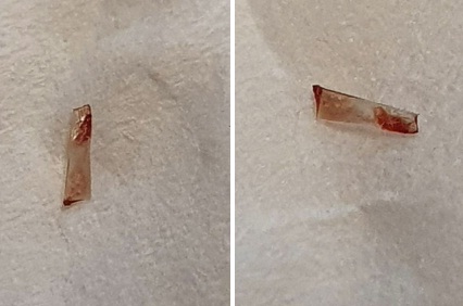 Verdacht Shedding
                20.10.2021: Splitter unter Fingernagel herausgeholt