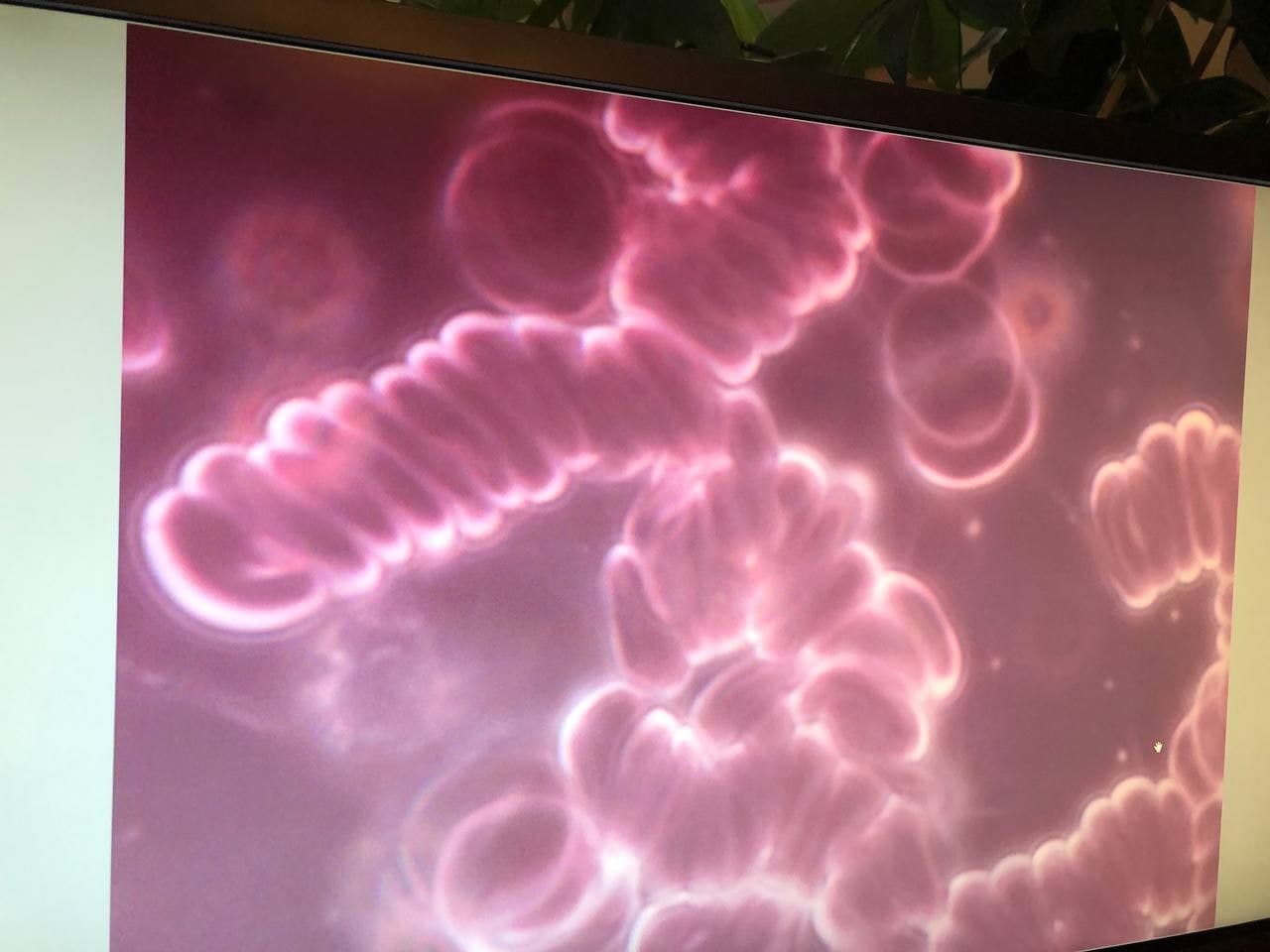 Blut kaputt nach GENimpfung 6.11.2021: Die roten
                  Blutk�rperchen sind "gestapelt"