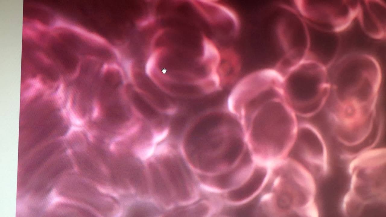 Blut kaputt nach GENimpfung 6.11.2021: Die
                    roten Blutk�rperchen sind "gestapelt"