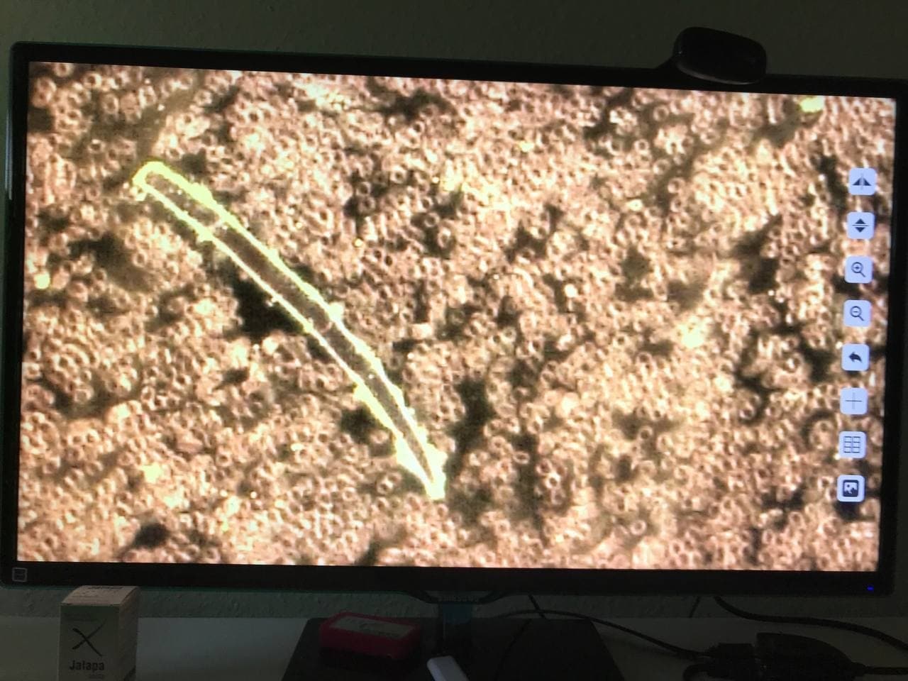 Blutbild nach
                  GENimpfung: Verklebte Blutk�rperchen+Fremdk�rper 3