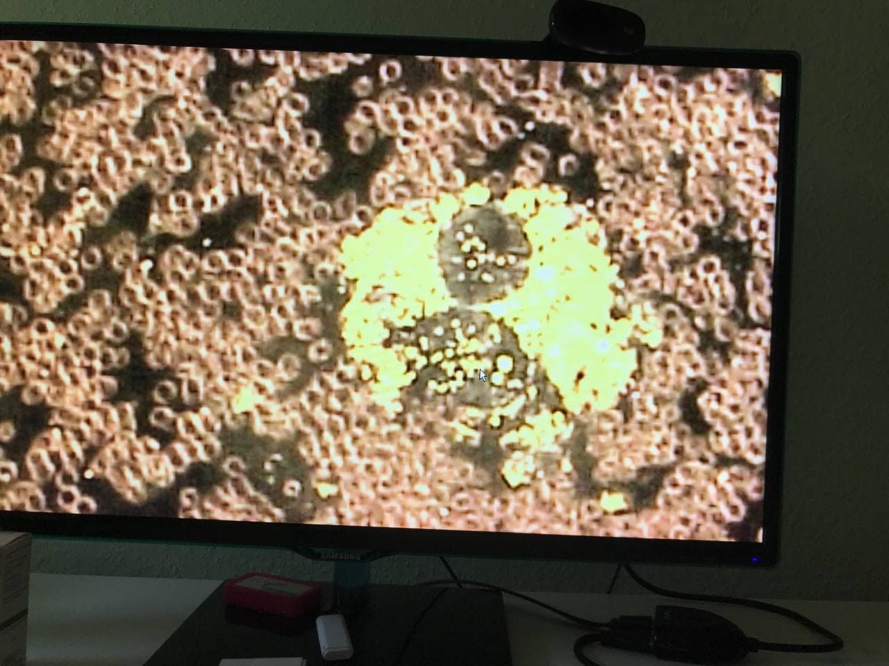 Blutbild nach
                  GENimpfung: Verklebte Blutk�rperchen+Fremdk�rper 4