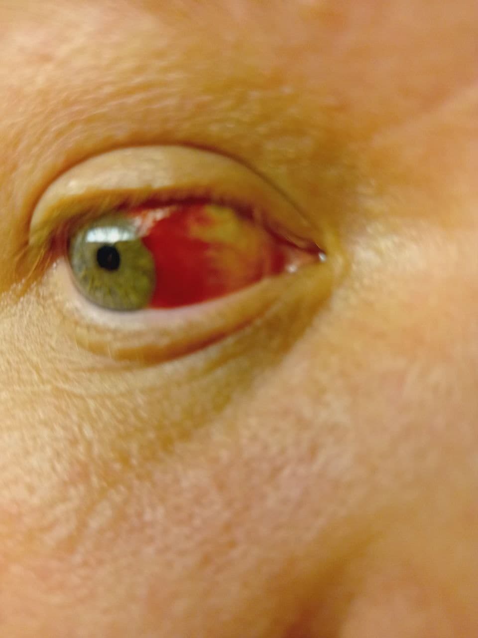 GENimpfschaden am
                        Auge Schweiz 30.11.2021: Rotes Auge