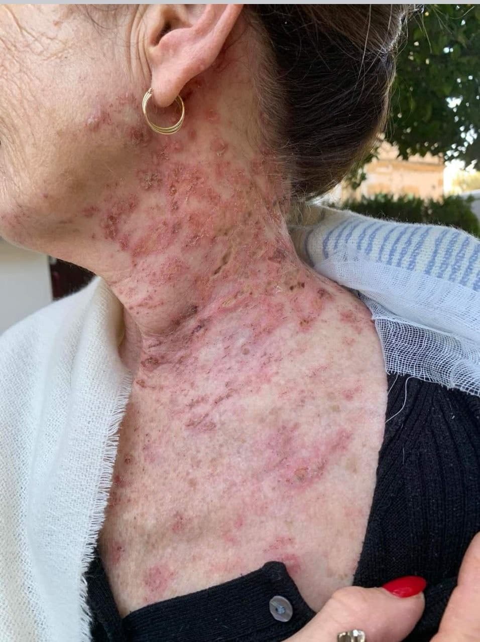 GENimpfschaden G�rtelrose 9.1.2022 02