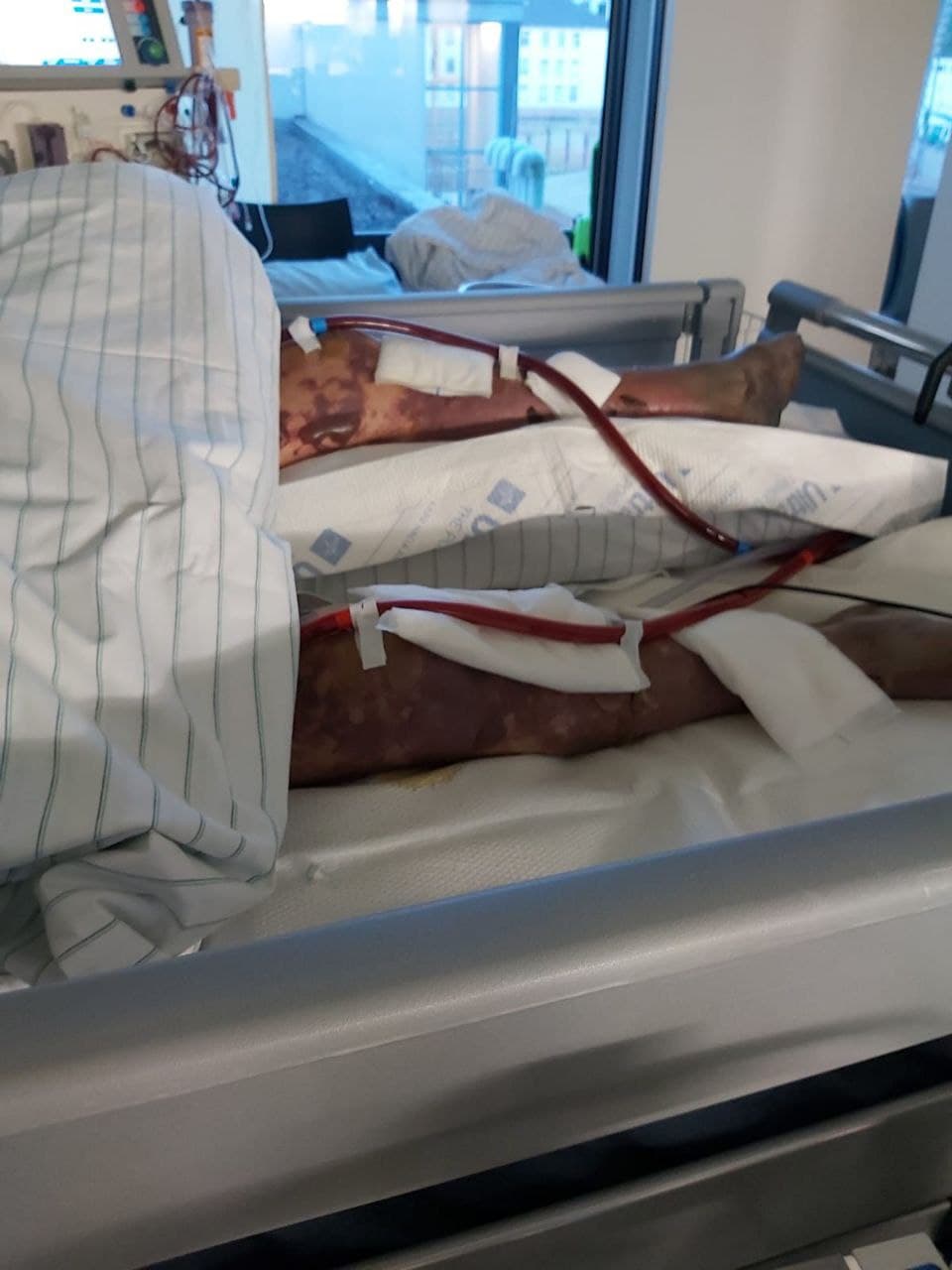 GENimpfmord NRW 21.1.2022: Person GENgeimpft
                  stirbt an gigantischen Thrombosen an den Beinen, Foto
                  1