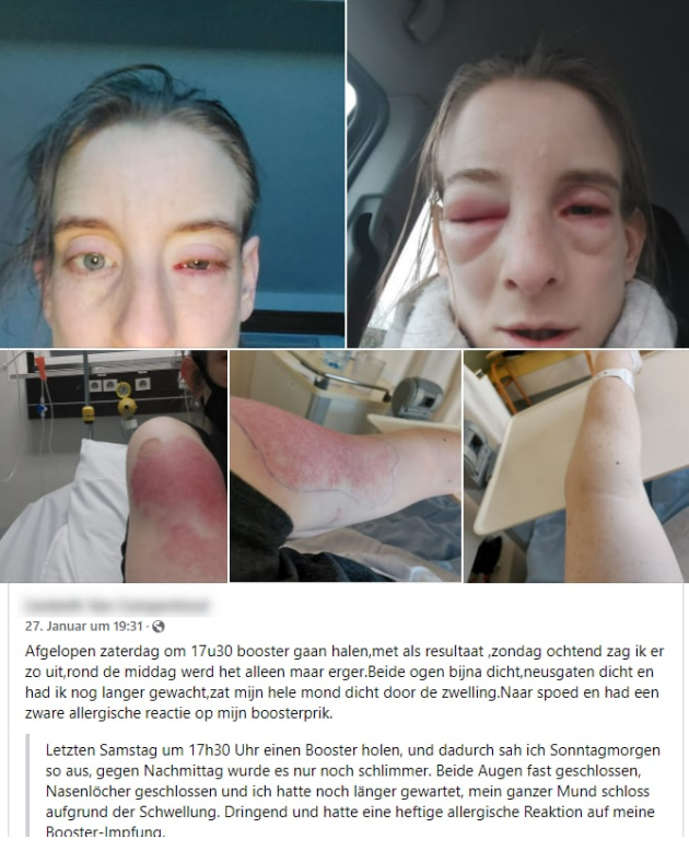 GENimpfschaden Belgien
                      29.1.2022: Frau 3x GENgeimpft bekommt Entz�ndungen
                      an Augen, Nase und im Rachenraum