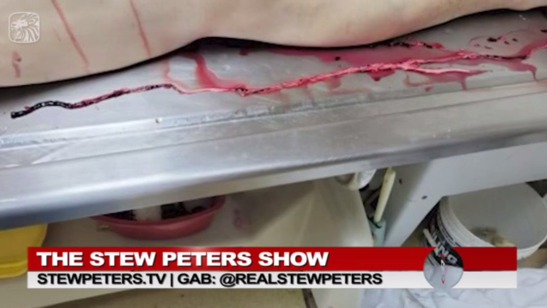 GENimpfung provoziert
                      weisse, gummiartige Blutgerinnsel, Meldung von
                      UncutNews am 31.1.2022, grosses Foto 02