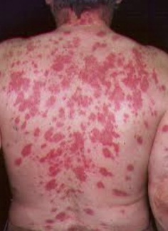 GENimpfschaden Misiones (Argentinien)
                    21.2.2022: Frau 3x GENgeimpft hat Flecken am ganzen
                    R�cken - Meldung vom 15.2.2022: Misiones, Argentina:
                    Luego de la tercera dosis, mujer sufre efectos
                    adversos. El audio es del d�a 15 de febrero.