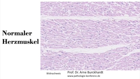 Herzmuskel in gesundem Zustand:
                    Alle Fasern sind parallel