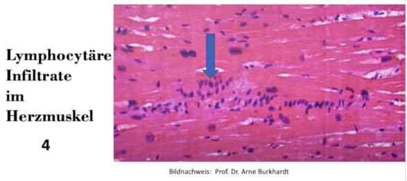 Herz
                    nach Herzmuskelentz�ndung: T-Lymphozyten stapeln
                    sich im Muskel wie Geldrollen