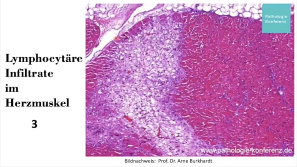 Herz nach
                    Herzmuskelentz�ndung: T-Lymphozyten decken im Muskel
                    ganze Bereiche ab