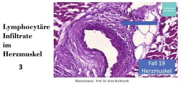 Herz nach
                    Herzmuskelentz�ndung: Entz�ndungen an den
                    Gef�ssw�nden