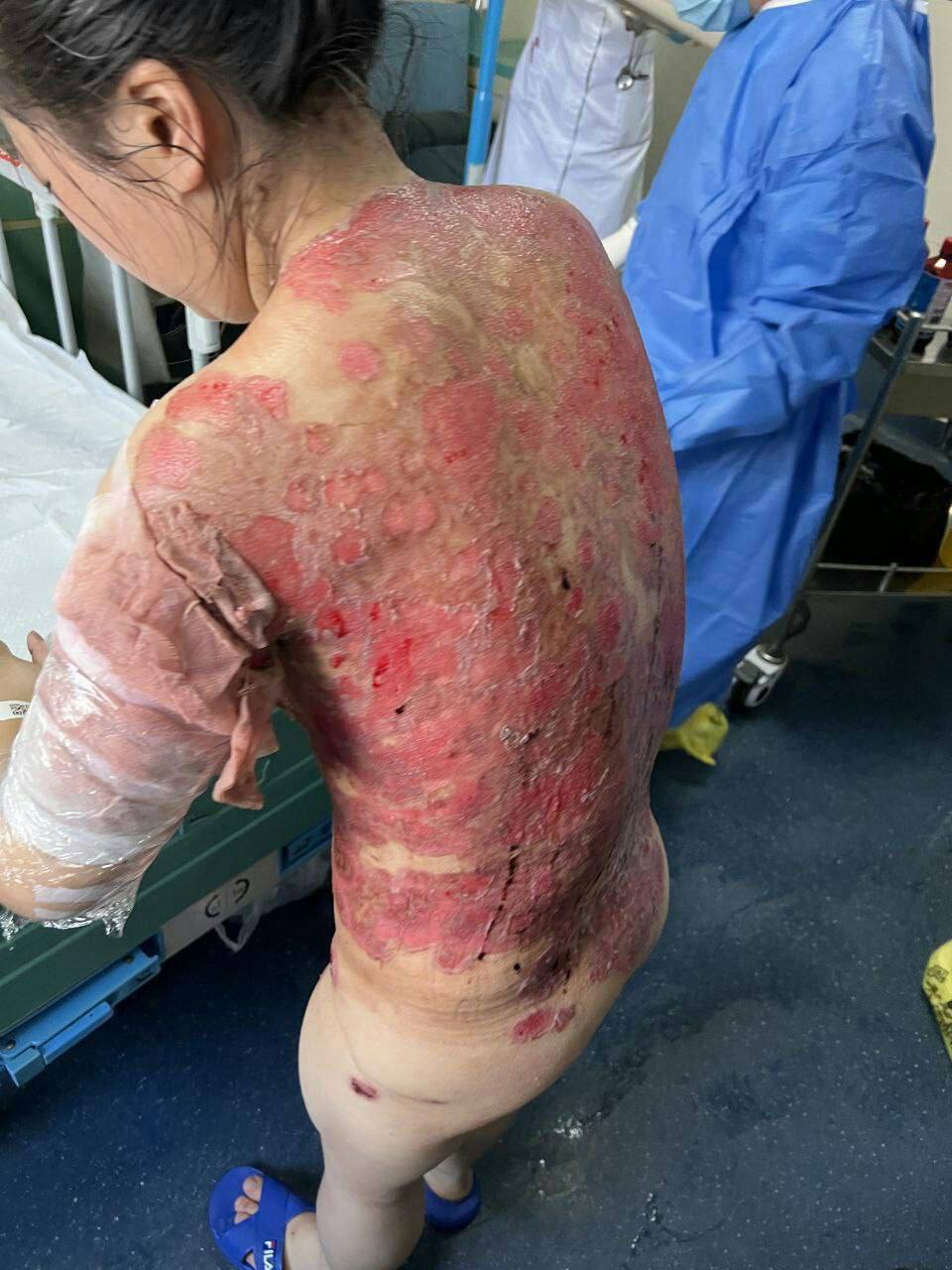 GENimpfschaden China 14.4.2022: Haut platzt
                  auf