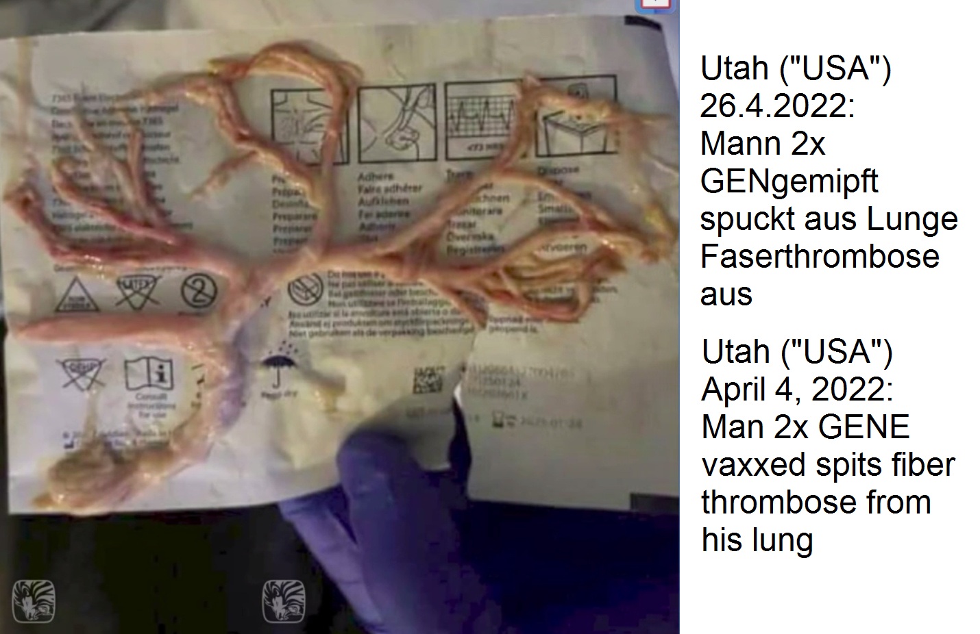 GENimpfschaden in Utah
                  ("USA") 26.4.2022: 2x GENgeimpfter Mann (32)
                  spuckt Faser-Thrombose in Form der Lungenwege aus:
                  Utah ICU Nurses Try To Hide Fibrous Clot Coughed Up By
                  Jabbed 32 Year Old
