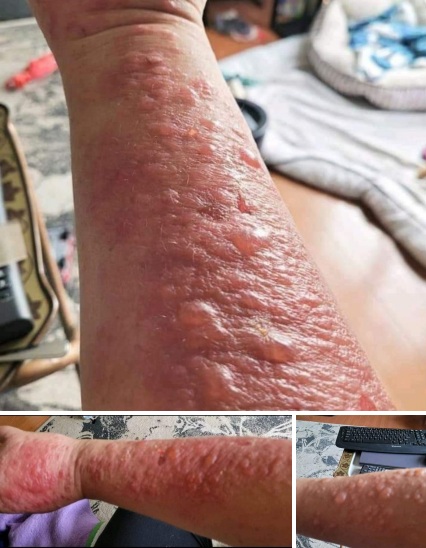 Verdacht
                  SCHLANGENGIFTimpfschaden "USA" 1.5.2022:
                  Ausschlag mit Blasen auf der Haut an den Armen