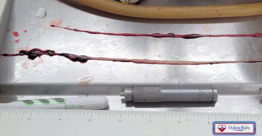 Einbalsamierer Richard Hirschmann zeigt
weisse Faserblutgerinnsel 05 mit Längenmass Einbalsamierer Richard Hirschmann zeigt weisse
Faserblutgerinnsel 05 mit Längenmass