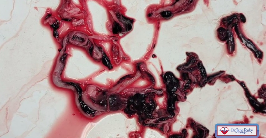 Einbalsamierer Richard Hirschmann zeigt weisse
Faserblutgerinnsel 04, die noch blutig sind Einbalsamierer Richard Hirschmann zeigt weisse
Faserblutgerinnsel 04, die noch blutig sind